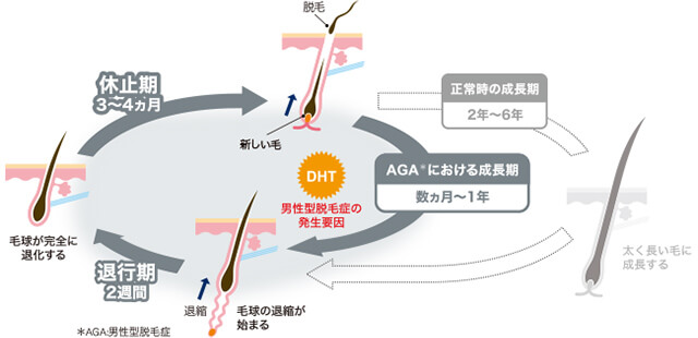 AGA(男性型脱毛症)